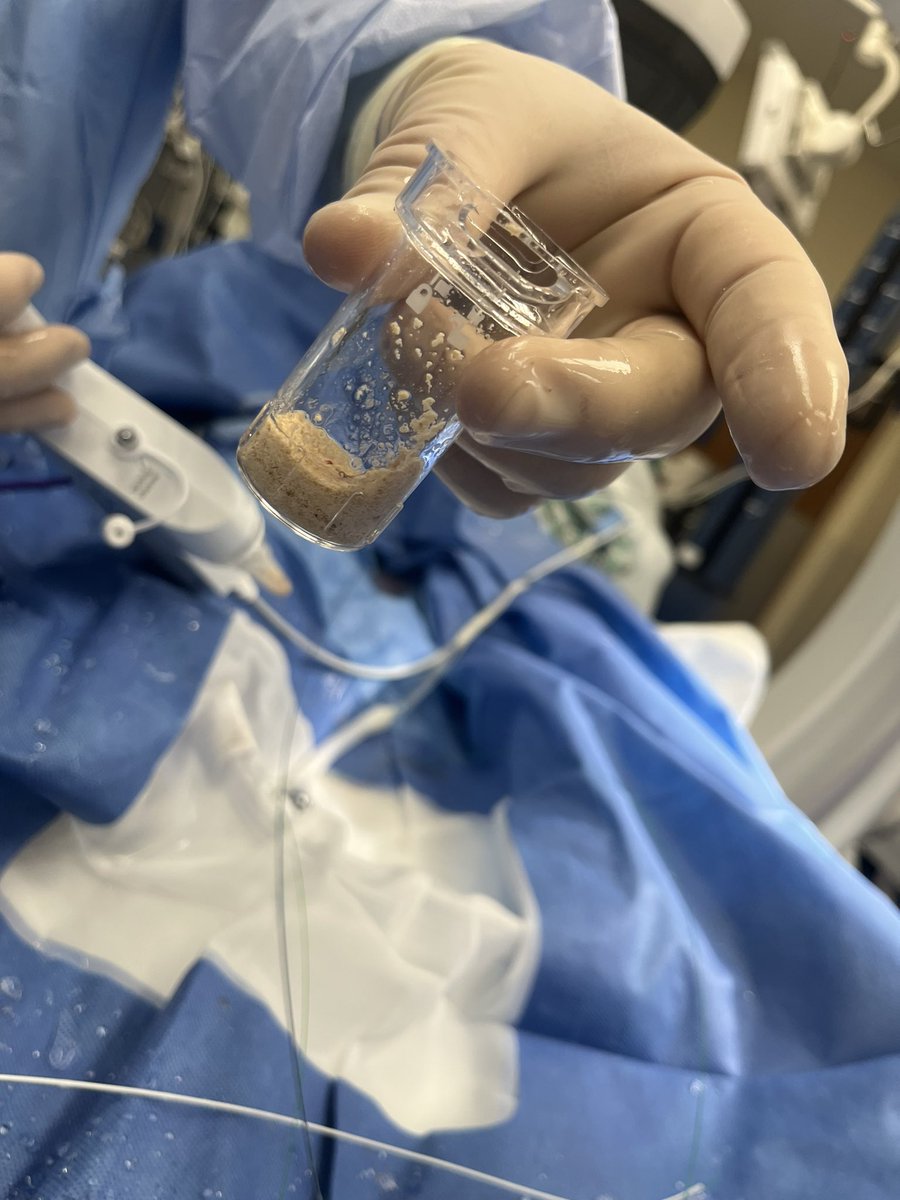 44 yo female with BLE contractures and bilateral staghorn calculi requiring  multiple staged URS/HLL procedures previously.  Now with 3.5 cm total stone burden on right 2 yrs later.  98% stone clearance in one procedure with CVAC.  Vastly improved outcome.