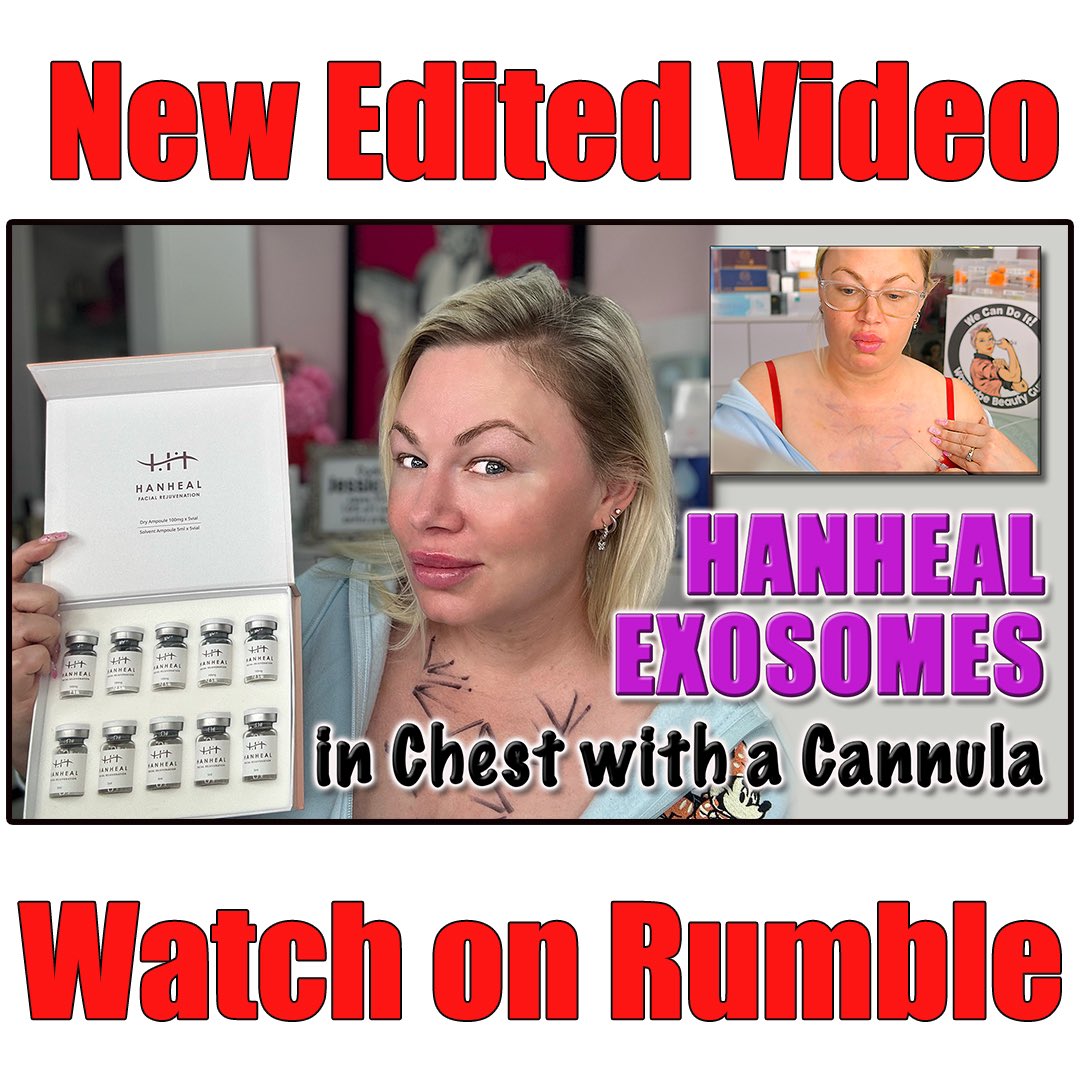 New edited video 
Using a cannula to treat the chest with hanheal
Exosomes! With practice this method will help reduce bruising 🙂

Watch now on rumble rumble.com/v4tbhpz-hanhea…

I get my hanheal exosomes at AceCosm and code Jessica10 saves you money 

#hanhealexosome