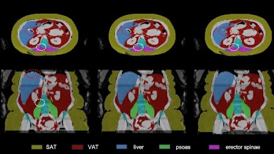 Automated body composition analysis on #MRI sheds light on sex-specific metabolic response to caloric restriction and weight loss doi.org/10.1148/ryai.2… @EsgarSociety #ESGAR2024 #AbdRad