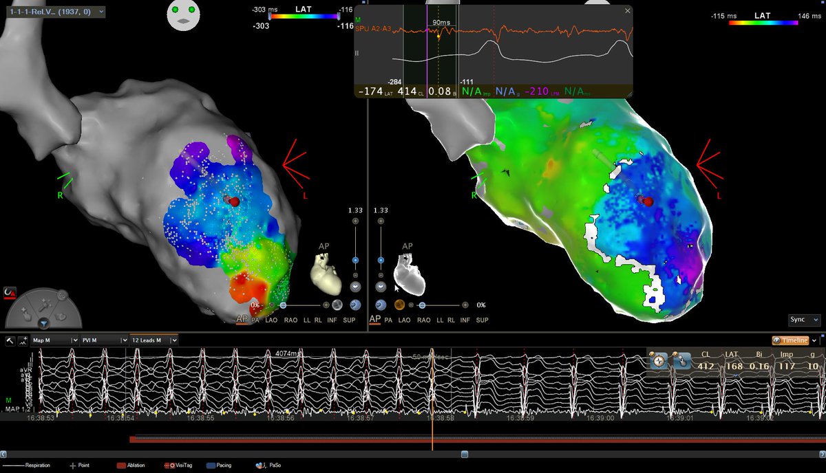Filippo Maria Cauti (@filippocauti) on Twitter photo Even though these maps are getting mesmerizing, VT interruption is driven by visual #VEDUM point termination during ongoing VT.
4 sec to affect the slowest area inside a huge VT isthmus.
EGM duration = slow conduction
@BiosenseWebster
#òpurpo <a href="/CerrutoGiuliano/">Giuliano Cerruto</a> <a href="/PietroRossiEP/">Pietro Rossi</a> Even though these maps are getting mesmerizing, VT interruption is driven by visual #VEDUM point termination during ongoing VT.
4 sec to affect the slowest area inside a huge VT isthmus.
EGM duration = slow conduction
@BiosenseWebster
#òpurpo <a href="/CerrutoGiuliano/">Giuliano Cerruto</a> <a href="/PietroRossiEP/">Pietro Rossi</a>