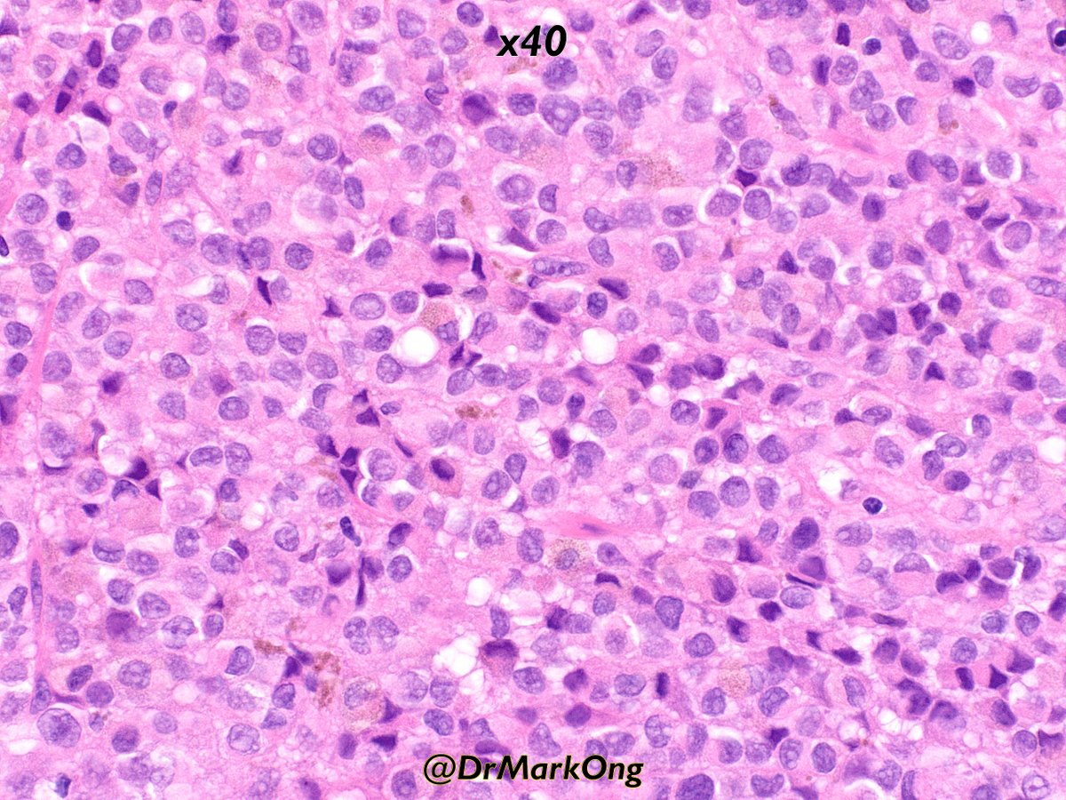 Mark Ong (@drmarkong) on Twitter photo Duodenal mass.
Can you make a diagnosis on H&E alone?
#GIpathology #pathology Duodenal mass.
Can you make a diagnosis on H&E alone?
#GIpathology #pathology