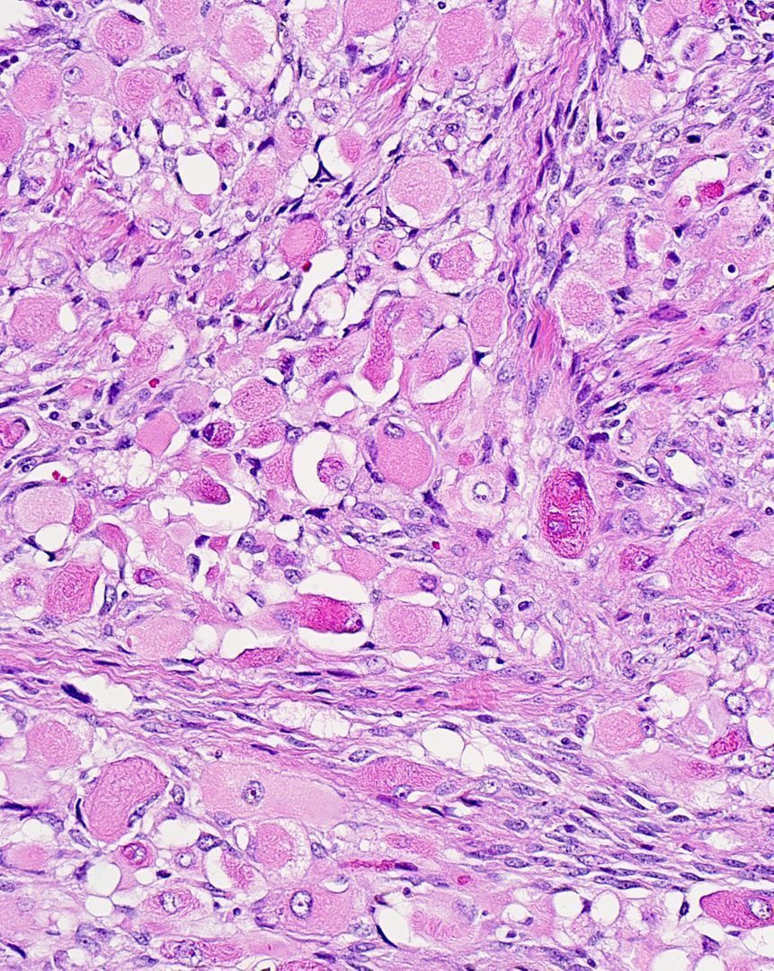 What are these atypical cells with abundant eosinophilic fibrillary/stringy cytoplasm? What stains could you use to identify them? More pics: kikoxp.com/posts/16855 Answer: youtube.com/watch?v=LBgsIa… 101 video: youtube.com/watch?v=5szCMG… #BSTpath #pathology #pathTwitter