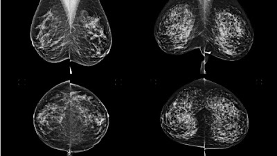 #DeepLearning for Breast Cancer Risk Prediction: Application to a Large Representative UK Screening Cohort doi.org/10.1148/ryai.2… @RoyalSurrey @UniOfSurrey #mammo #BreastCancer #AI