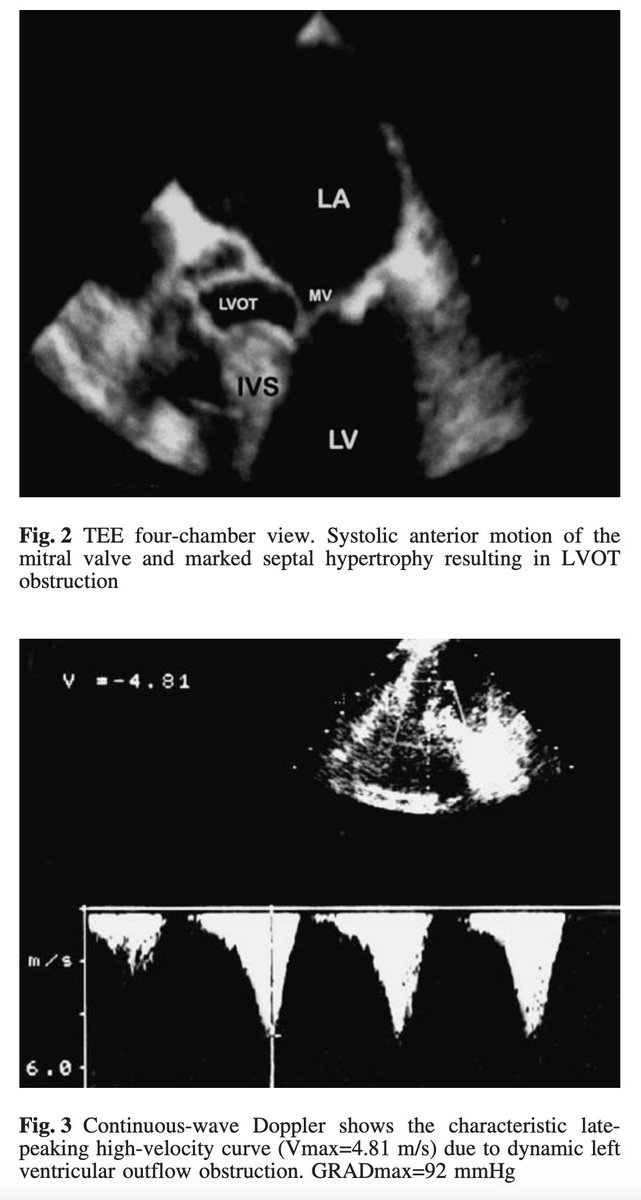 A TEE was performed & showed typical echo pattern of hypetrophic cardiomyopathy w septal hypertrophy of 2.1 cm, systolic anterior motion of the mitral valve, severe mitral regurgitation and dynamic left ventricular outflow tract (LVOT) obstruction gradient of 92 mmHg