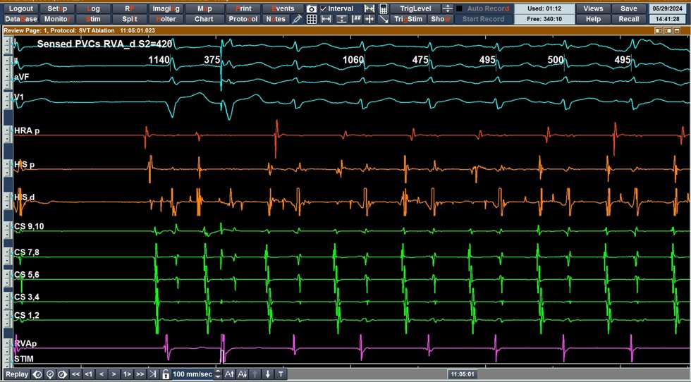 What is the mechanism of this tachycardia? A trace for EP fellows #EPeeps