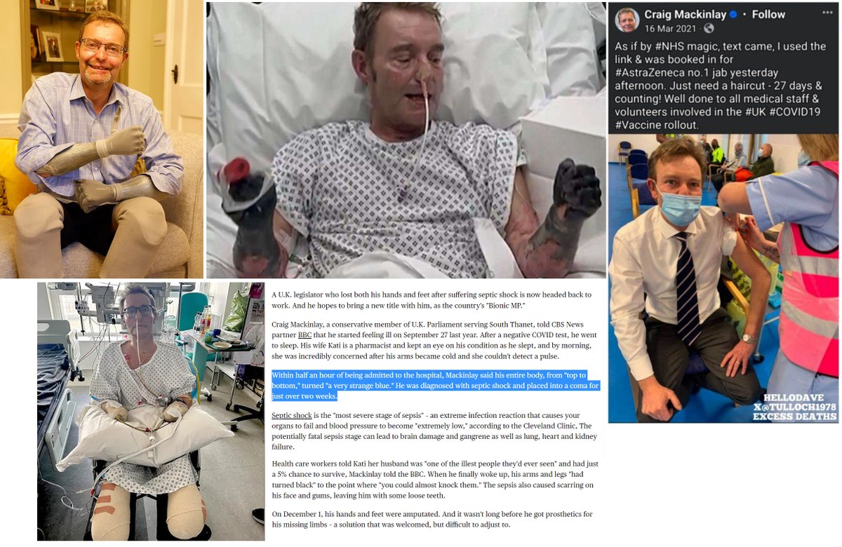 UK MP Craig Mackinlay developed septic shock after feeling ill on Sep.27, 2023. His hands and feet were amputated on Dec.1, 2023. I have written about dozens of cases of sepsis after COVID-19 Vaccination on my newsletter. COVID-19 mRNA Vaccines destroy the immune system, which