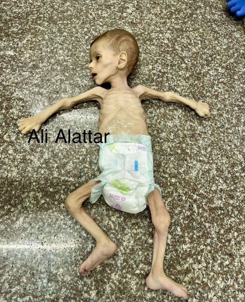 BREAKING: 7-month-old baby Fayez Abu Ataya was just announced dead as a result of malnutrition and the lack of medical treatment under Israeli war of starvation in the Gaza Strip.