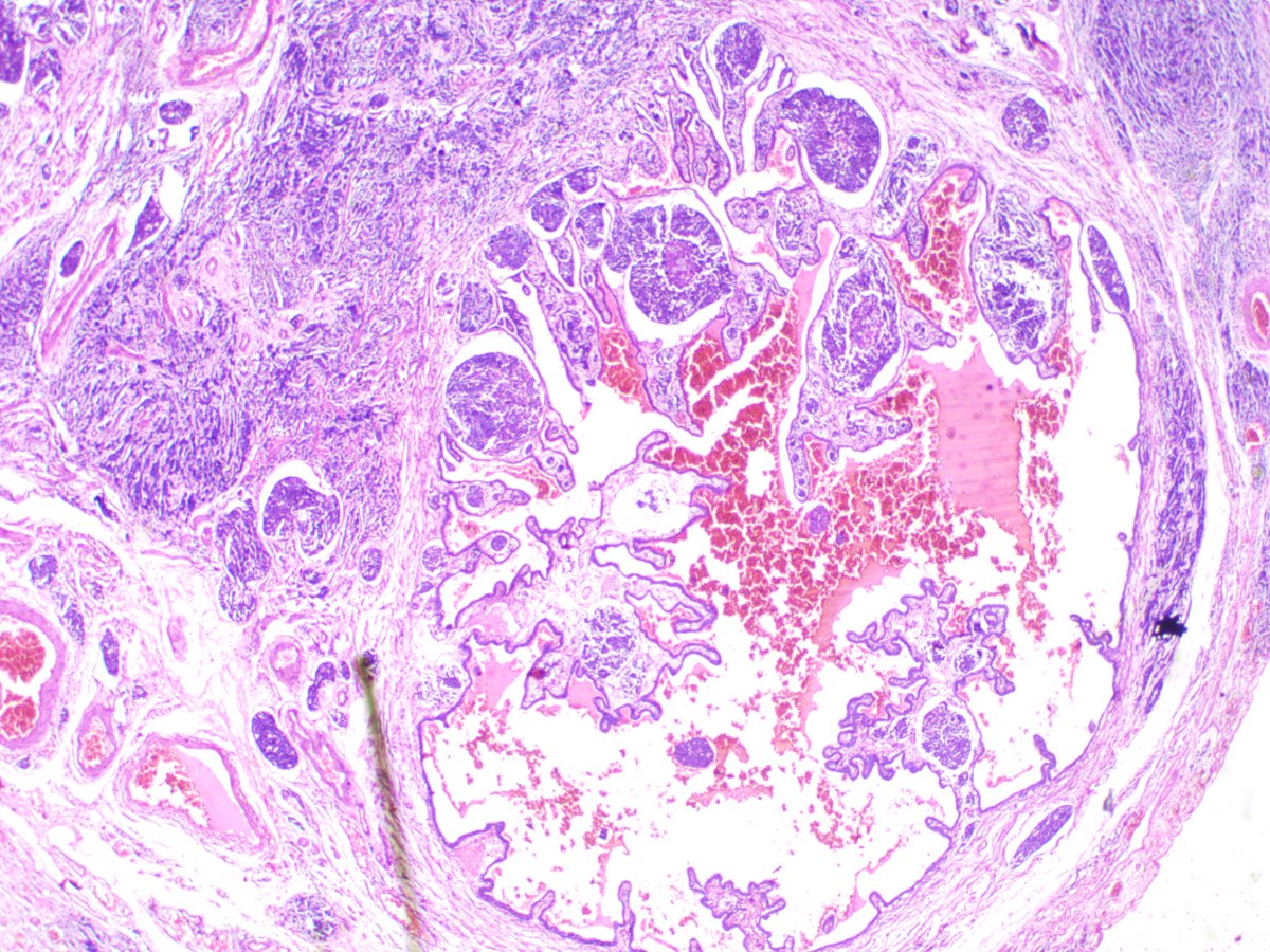 NewjobiRakesh's tweet photo. 50/F, FT, Is it primary or secondary? #pathology #pathresidents #pathtwitter #FGTPath https://t.co/G6jpsrQa9L