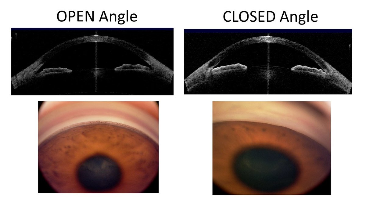 I am surprised nobody could get it!!

I would like to rule out 3 important causes:

1. Unrecognised angle closure
2. Inflammation
3. Neovascularization of the angle

#MedTwitter #MedEd #ophthalmology #glaucoma
Images from google