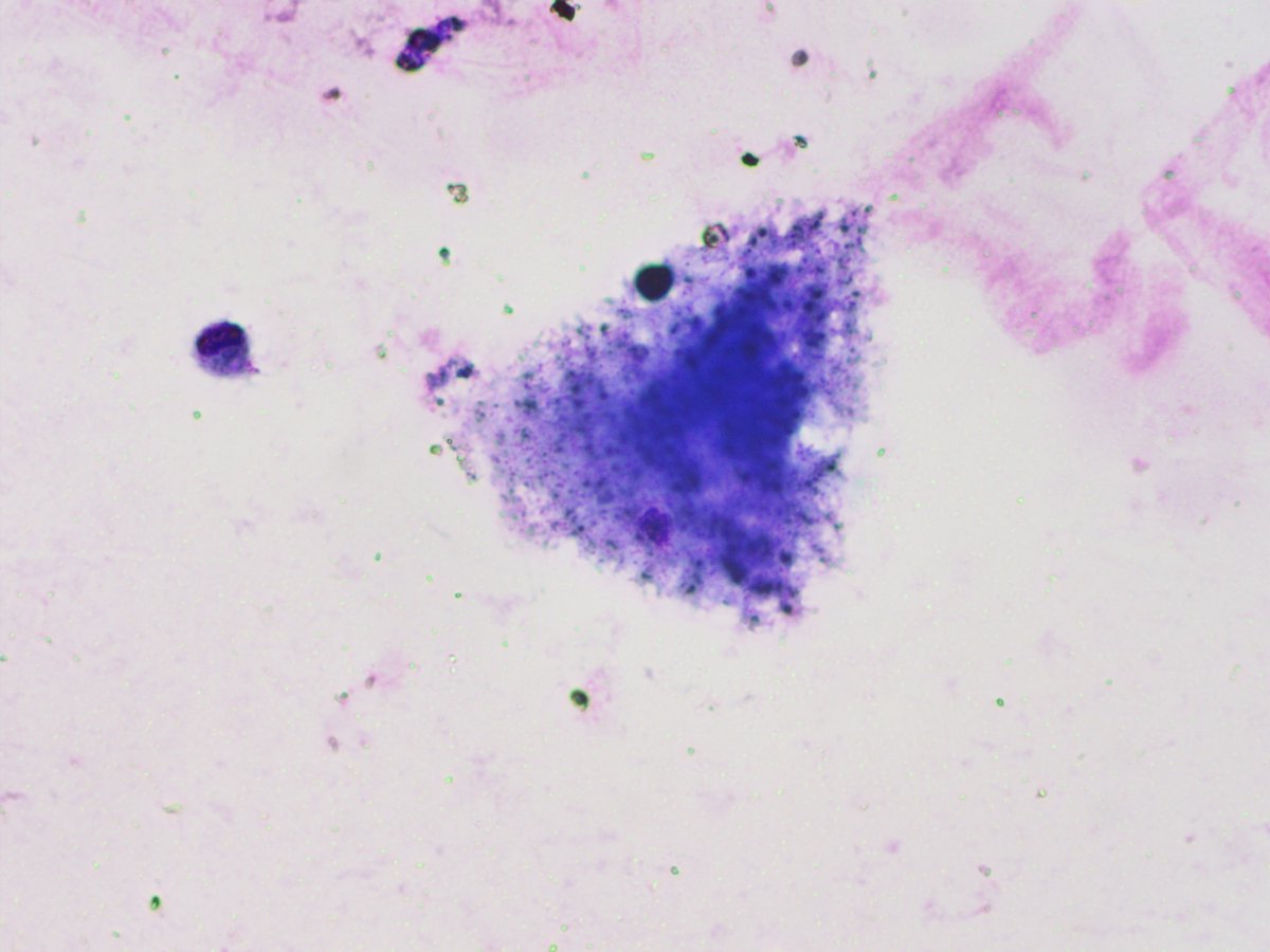 NewjobiRakesh's tweet photo. PLHA BAL FLUID. Spotter #cytopath #pathology #pathresidents #pathtwitters #pulmopath https://t.co/r2zvrnhRN5