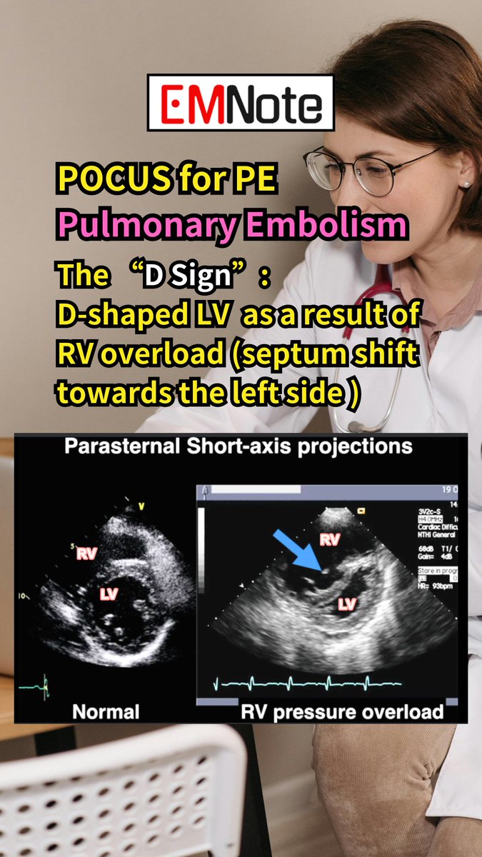 Pulmonary Embolism Ultrasound. youtube.com/shorts/C5DMOGj… The McConnell’s sign is defined as RV free wall akinesis with sparing of the apex.