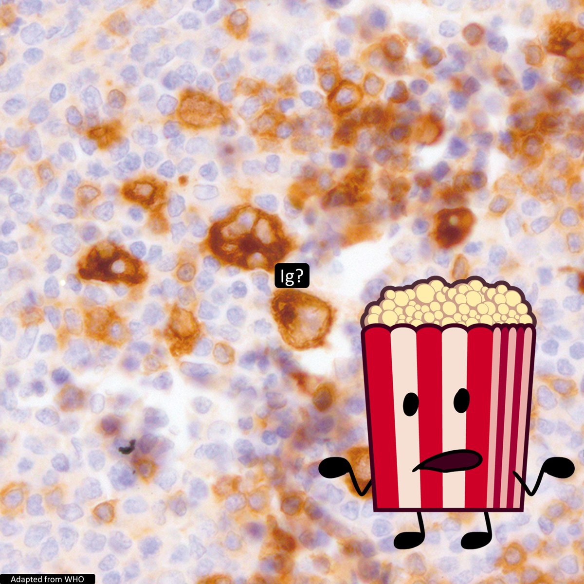 Ig__ expressing LP cells in NLPHL are associated with ___ #HemePath #PathTwitter #Pathology