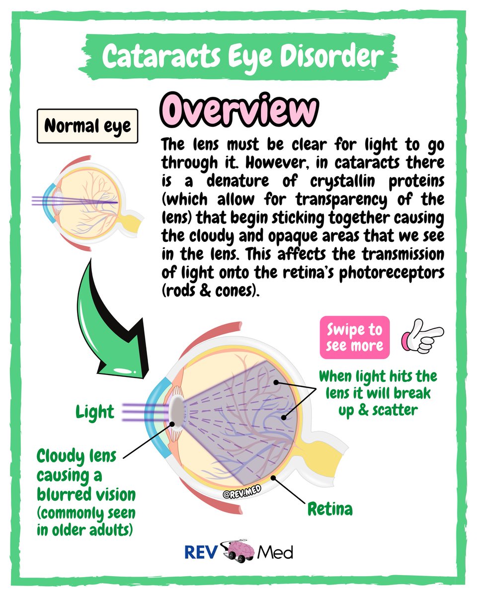 REVMED_'s tweet photo. Who knew how clear you can after learning Cataracts with us! 👀 full post on REV MED https://t.co/PYlD4eeYW7