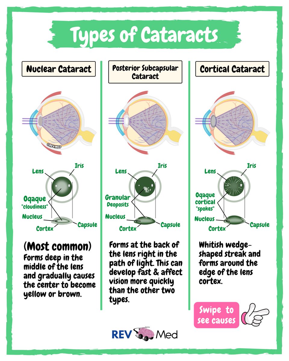 Who knew how clear you can after learning Cataracts with us! 👀 full post on REV MED