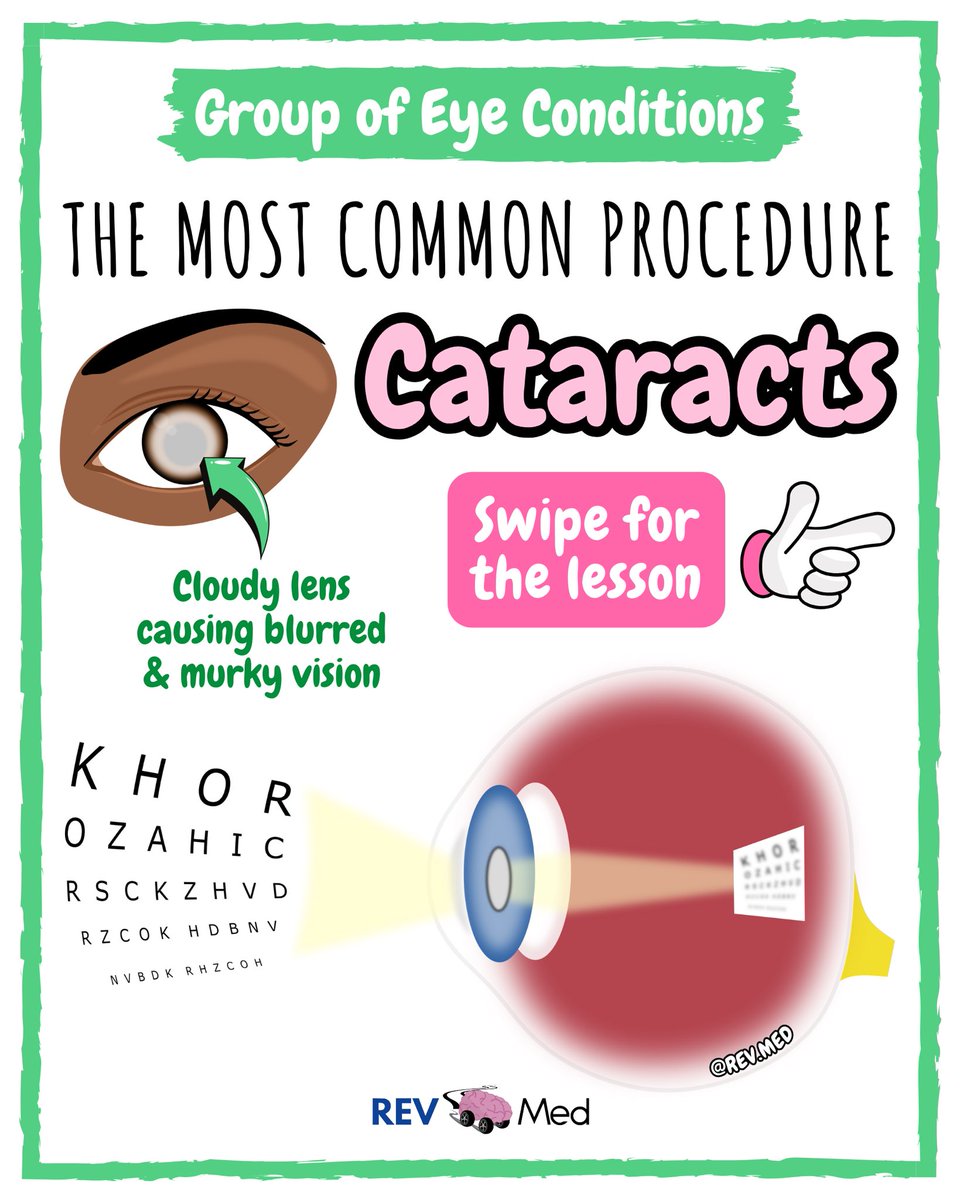 REVMED_'s tweet photo. Who knew how clear you can after learning Cataracts with us! 👀 full post on REV MED https://t.co/PYlD4eeYW7