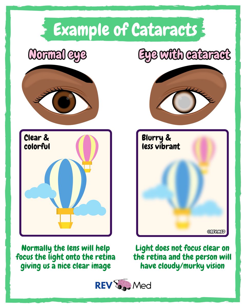 REVMED_'s tweet photo. Who knew how clear you can after learning Cataracts with us! 👀 full post on REV MED https://t.co/PYlD4eeYW7