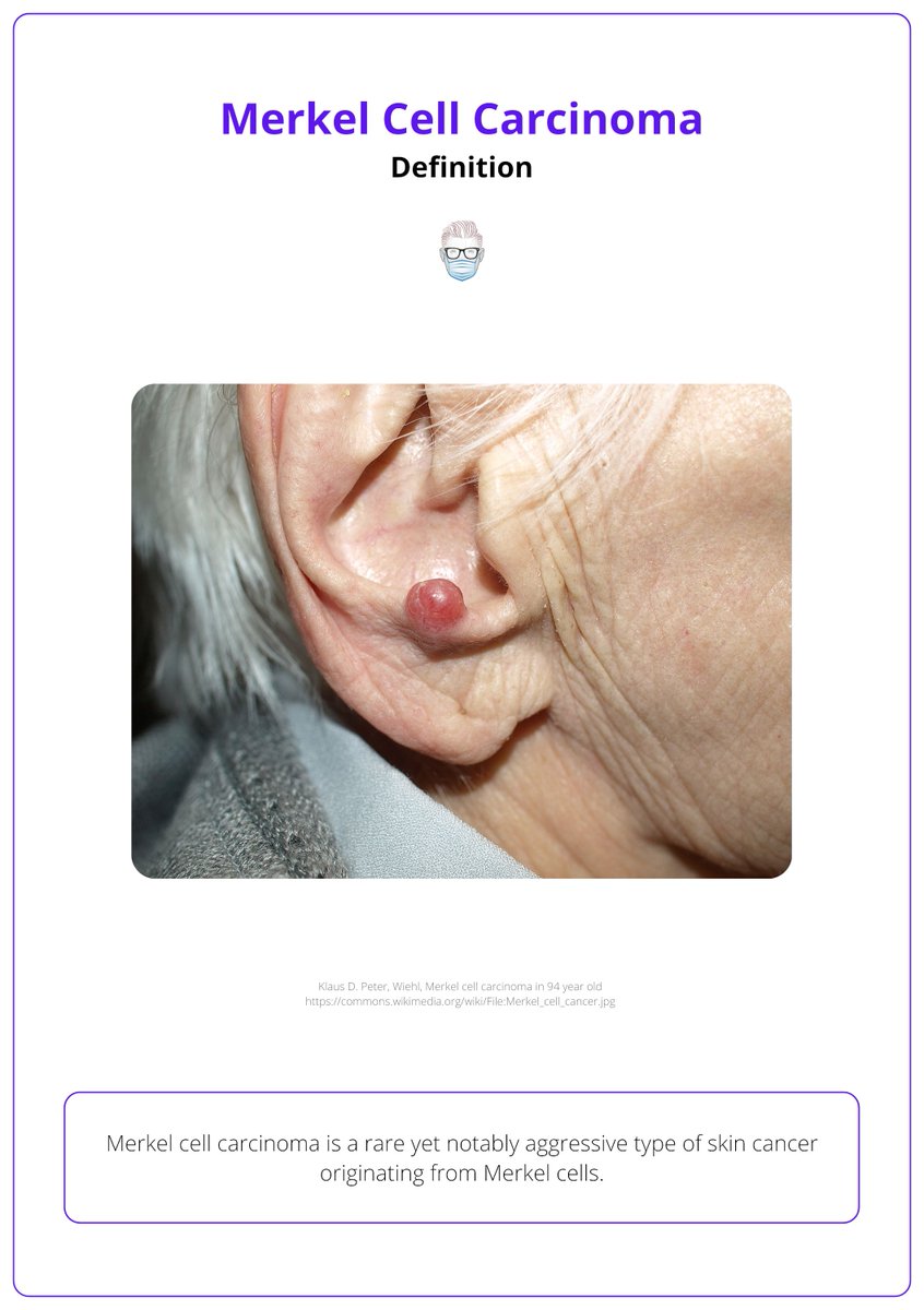 PlasticsFella's tweet photo. #ThreadThursdays
Let’s talk Merkel Cell Carcinoma (MCC).
MCC is a rare but aggressive skin cancer. It often shows up as a shiny, fast-growing nodule. https://t.co/gZVR3rRBOL