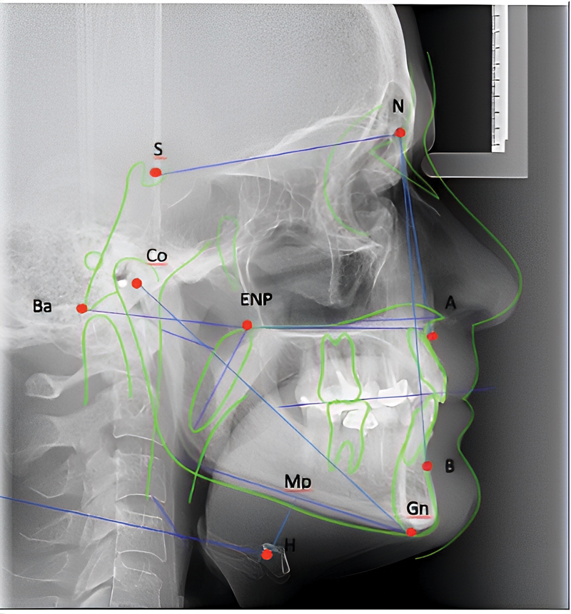 IAORL_Journal's tweet photo. Original Research Article: This study assesses whether patients with worse #craniofacial positioning present with worse preoperative polysomnography data and more
🔗https://t.co/bWzs3n48m6
#sleepapnea #cephalometry #lateralpharyngoplasty #ENT #OpenAccess #MedTwitter https://t.co/kuveBtoI0f