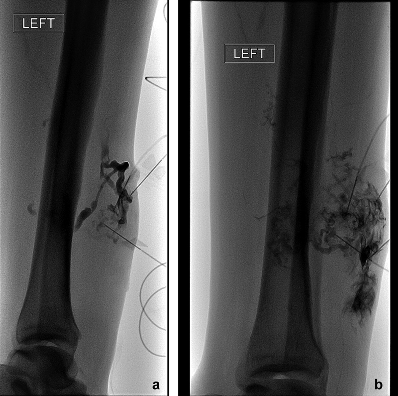Back to Basics Article: Embolic Agents: Sclerotherapy
🔗thieme-connect.com/products/ejour…
#embolicagents #sclerotherapy #sclerosants #irad #radtwitter #radiology #MedTwitter