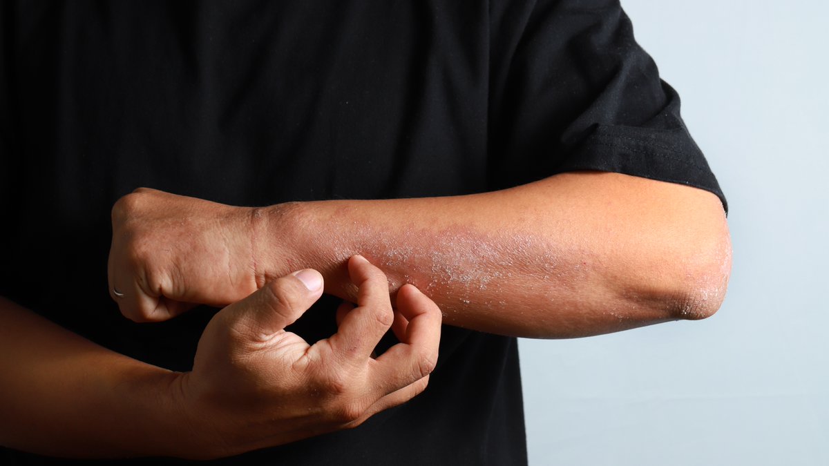 New research reveals Th2-MPP cells might be key to allergic reactions and chronic diseases like asthma and atopic dermatitis. Findings from <a href="/MassGeneralNews/">MassGeneral News</a>, <a href="/BrighamWomens/">Brigham and Women's Hospital</a>, and <a href="/MassEyeAndEar/">Mass Eye and Ear</a> researchers pave the way for innovative therapies. spklr.io/6012qXos