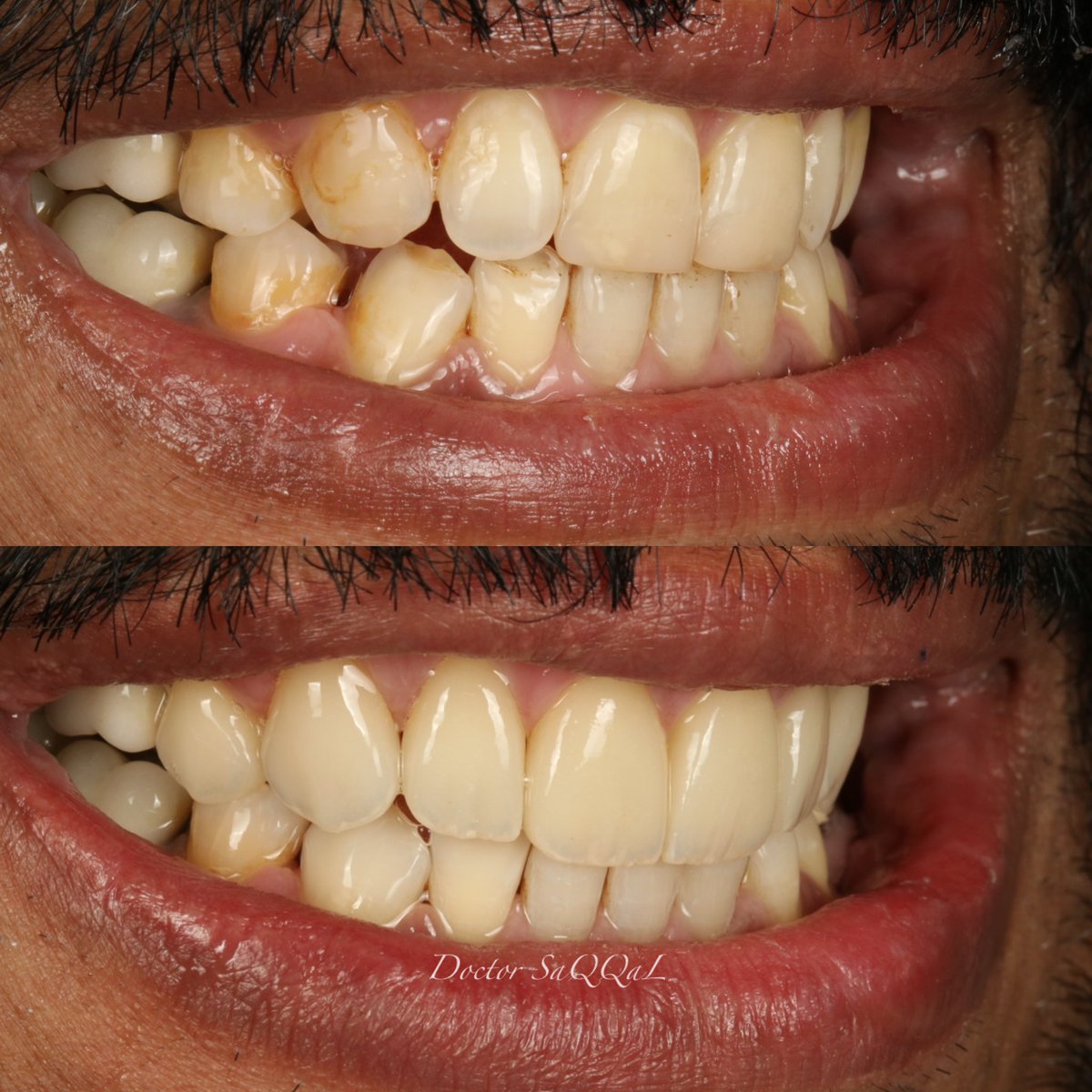 dr_saqqal's tweet photo. شور خزفيه (veneer) للأسنان الأماميه العلويه و وجوه جزئيه مباشره من الكومبوزت المقوى للأسنان الاماميه السفليه ( empress direct ) هذا بهدف الوصول لأكثر النتائج التجميلية الممكنه و بالإضافة إلى التقنية العلاجية المحافظه على الأسنان الطبيعيه. #empress_direct #veneer #cosmetic #فينير https://t.co/cNPI35XP7i