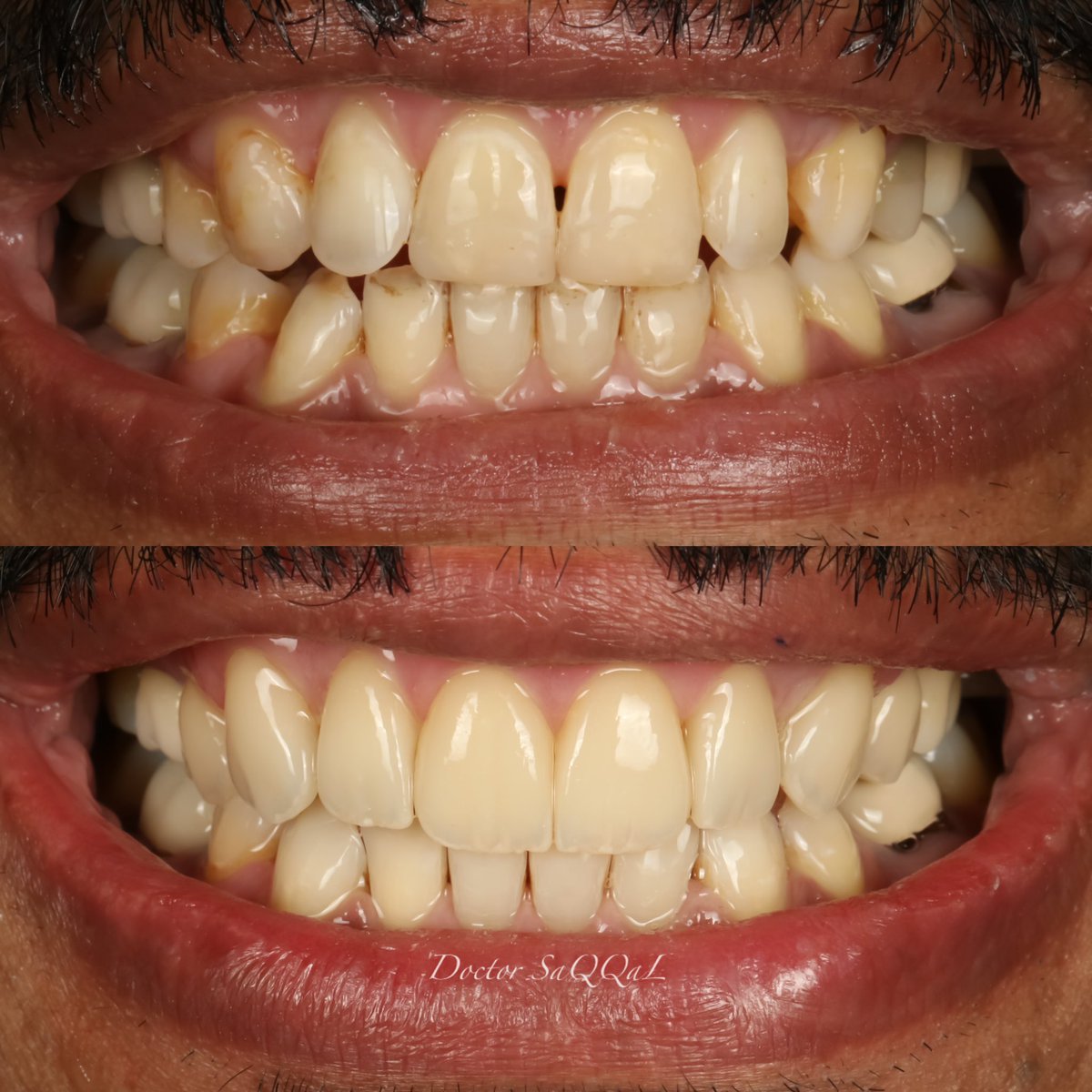 dr_saqqal's tweet photo. شور خزفيه (veneer) للأسنان الأماميه العلويه و وجوه جزئيه مباشره من الكومبوزت المقوى للأسنان الاماميه السفليه ( empress direct ) هذا بهدف الوصول لأكثر النتائج التجميلية الممكنه و بالإضافة إلى التقنية العلاجية المحافظه على الأسنان الطبيعيه. #empress_direct #veneer #cosmetic #فينير https://t.co/cNPI35XP7i