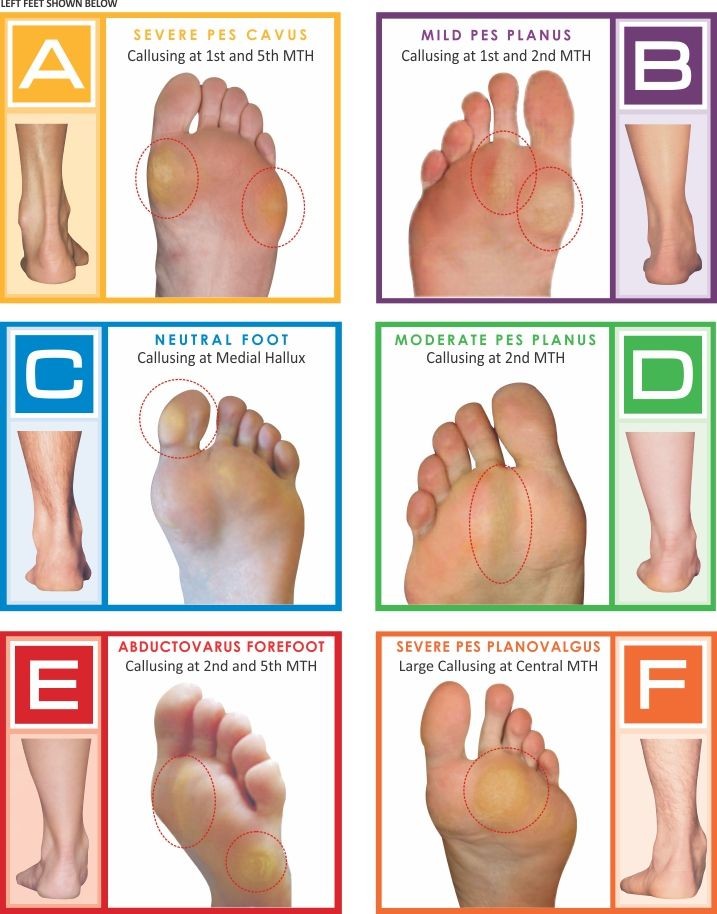 ♦️Calluses:
flattened areas of thickened skin of HEELS,BALLS of FEET &amp;SOLES which are larger with more diffuse shape &amp; less painful,compared to corns.

♦️Corns:
small areas of hardened skin typically have a raised center,found on tops&amp;sides of TOES

Image: nolaro24.com