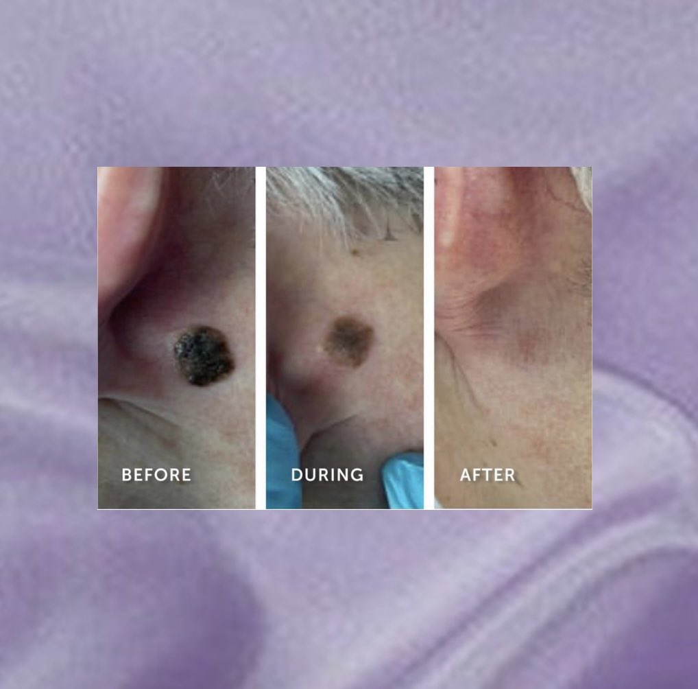 SCINCLINIC's tweet image. Seborrheic Keratosis can affect older adults of all skin types! They often look like warts &amp;amp; possess a soft, velvety feel when touched.
With the magic of CryoPen you can say goodbye to these pesky lesions.

Call/text Sarah on 07305909124 to arrange a consultation and treatment.