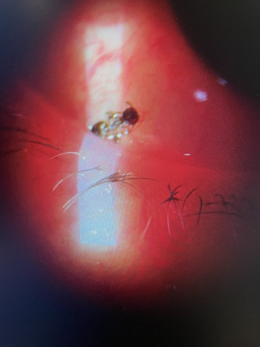 MarkGLee69's tweet photo. Today on What’s In Marks Eye: an ant biting into the eye itself.
☹️
0/5 stars, do not recommend. https://t.co/hduf8DxC4K