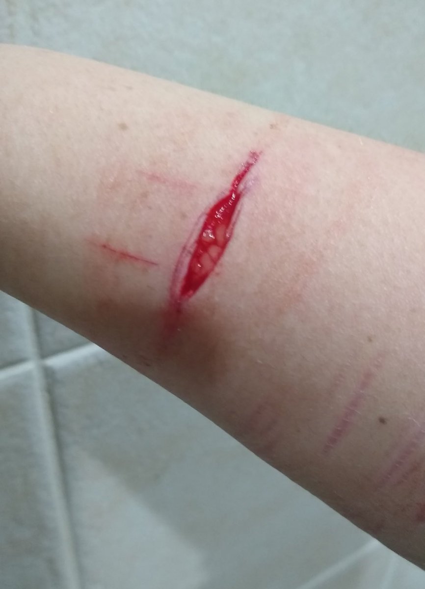 yakaiyon's tweet photo. My first subcutaneous fat cut (31 Dec 2021) to my biggest subcutaneous fat cuts (April 2023) https://t.co/XdaxDGOeig