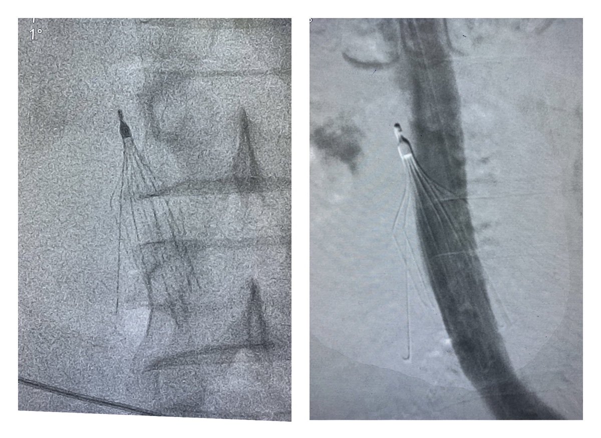 karananandpara's tweet photo. Case 66: with @BhaveshPopat7
.
IVC Filter retrieval, filter embedded, catheter/wire to tilt f/b snaring; images 👇
.
#medtwitter #meded #radiology #cardiotwitter #radres #futureradres #cardiology #filterout @SIRRFS @SIR_ECS @SIRspecialists @cirsesociety https://t.co/sQRTIEaeWW
