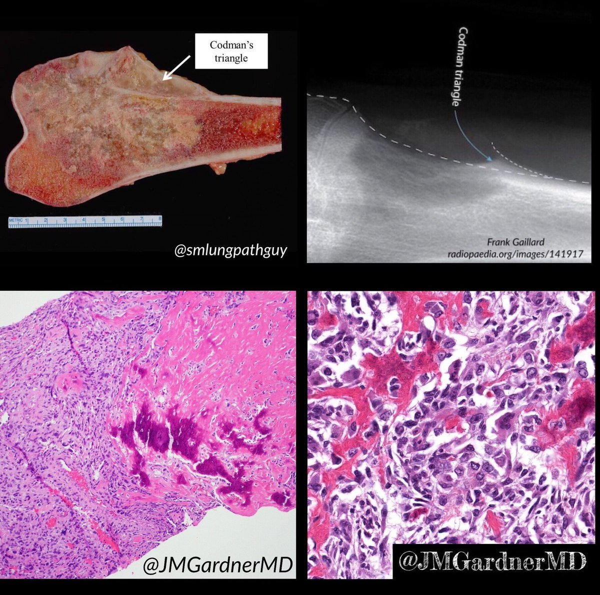 Bone lesion. Your diagnosis? Answer here: kikoxp.com/posts/4499 <a href="/smlungpathguy/">Sanjay Mukhopadhyay</a> <a href="/Radiopaedia/">Radiopaedia.org</a> #BSTpath #radpathmatch #radiology #sarcoma #pathologists #pathology #pathTwitter