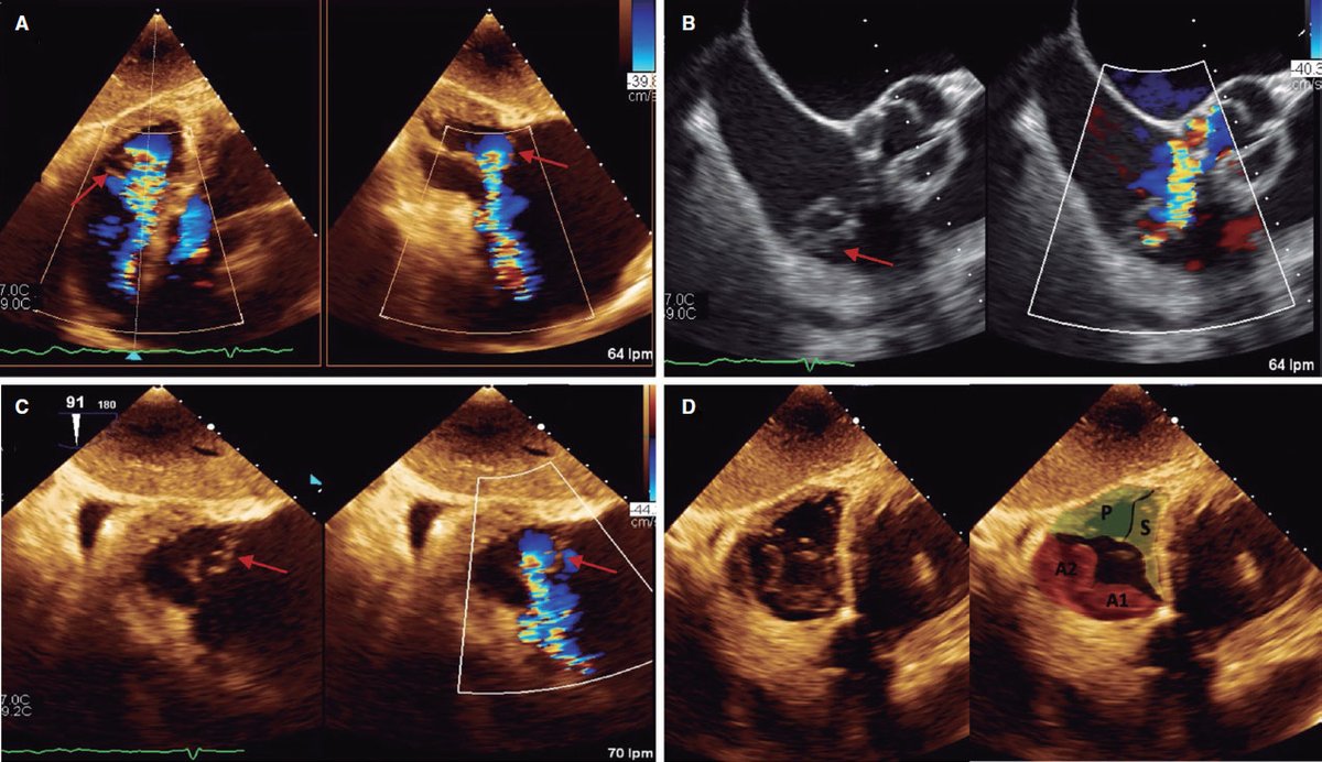 REC Publications (@revespcardiol) on Twitter photo Reparación tricuspídea percutánea «de borde a borde» en prolapso posterior aislado #recintervcardiol #AheadOfPrint <a href="/BetanzosJL/">José Luis Betanzos</a> <a href="/AlbertoAlperi/">Alberto Alperi</a> <a href="/iria_sc/">Iria Silva Conde</a> <a href="/PabloAvanzas/">Pablo Avanzas</a> <a href="/isaacpascual79/">Isaac Pascual</a> recintervcardiol.org/es/imagenes-en… Reparación tricuspídea percutánea «de borde a borde» en prolapso posterior aislado #recintervcardiol #AheadOfPrint <a href="/BetanzosJL/">José Luis Betanzos</a> <a href="/AlbertoAlperi/">Alberto Alperi</a> <a href="/iria_sc/">Iria Silva Conde</a> <a href="/PabloAvanzas/">Pablo Avanzas</a> <a href="/isaacpascual79/">Isaac Pascual</a> recintervcardiol.org/es/imagenes-en…