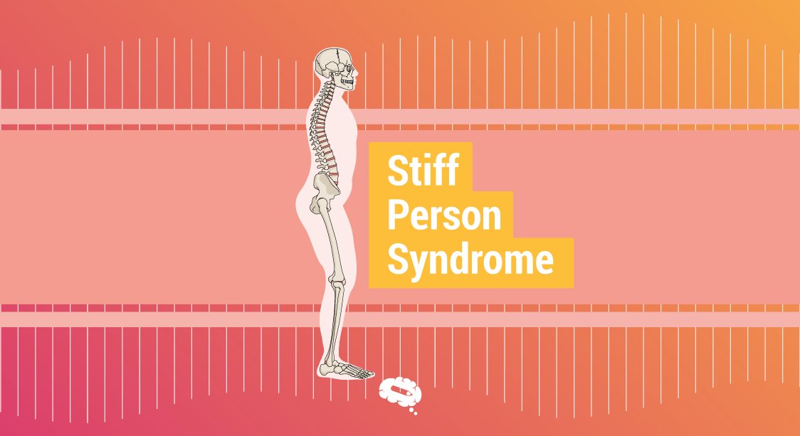 endocrinology20's tweet photo. Stiff-person syndrome and its subtype, stiff limb syndrome, are rare neurological disorders characterized by progressive muscular rigidity and spasms.
#Endocrinology #centralnervoussystem #neurotransmitter #enzyme #stifflimbsyndrome #muscles #glutamicacid #neurologicaldisorder https://t.co/i6OHif613r