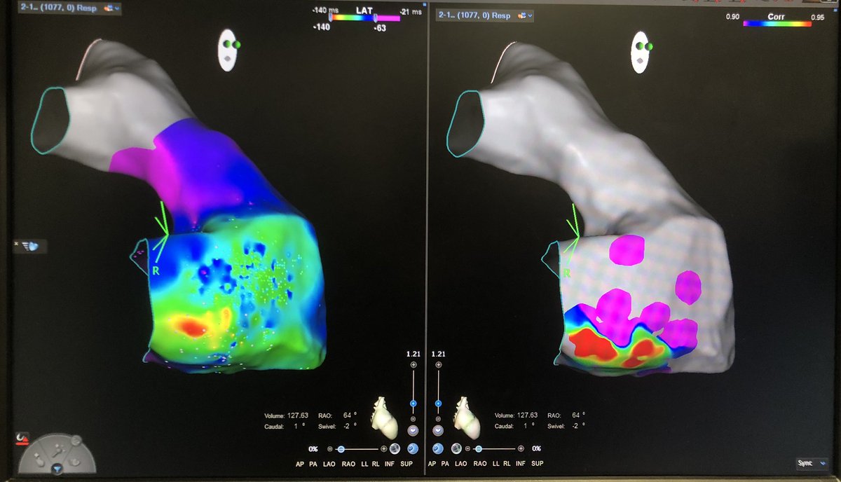 EduFrancoDiez's tweet photo. LAT map and pace-mapping map (PASO): basal inferolateral RV, near tricuspid annulus. https://t.co/xEmCiRg3VB