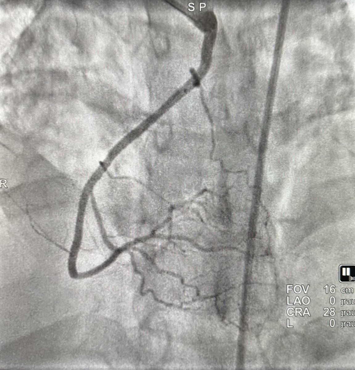 evandrofilhobr's tweet image. #ICFIT Subtotal occlusion of anomalous RCA (take off anterior/downward from left sinus, just beside LM stem). Diagnostic made in OSH (also crossover from radial to femoral) but report said they couldn’t PCI 🤷🏻‍♂️. Went femoral w/ multiples guides. Could probe and understand anatomy