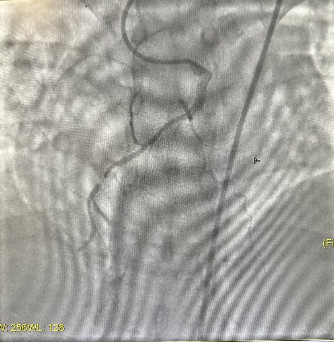 evandrofilhobr's tweet image. #ICFIT Subtotal occlusion of anomalous RCA (take off anterior/downward from left sinus, just beside LM stem). Diagnostic made in OSH (also crossover from radial to femoral) but report said they couldn’t PCI 🤷🏻‍♂️. Went femoral w/ multiples guides. Could probe and understand anatomy