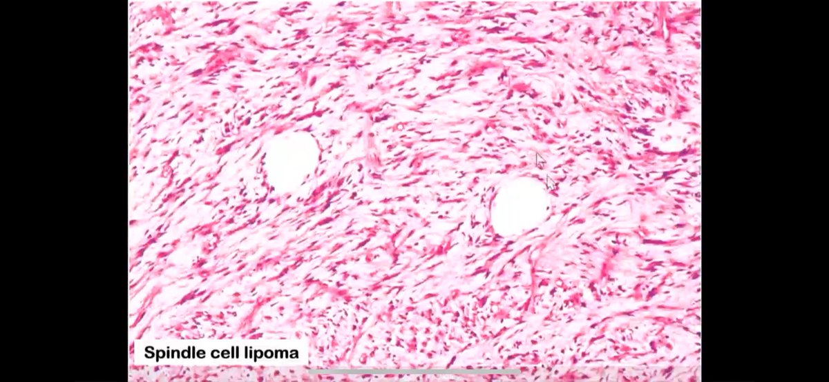 Janiranavarro's tweet photo. #everydayBST 
Spindle cell/pleomorphic lipoma
-Specific features shown in Pic 4
-If you see something that looks like spindle cell/pleomorphic lipoma BUT in different location/ not well circunscribed call it atypical spindle cell lipomatous tumor

Dr Goldblum  CCMPS #BSTPath  #pathtwitter #PathX #pathology #PathResident #NIPPathX