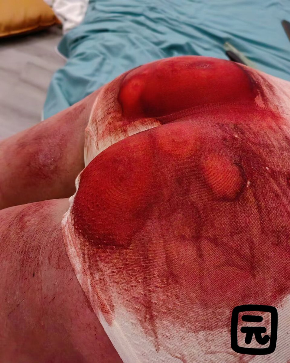 yydrcxb's tweet photo. 谢谢俺主人大发雷霆后送俺的血屁屁🌚🌚
#SP #spanking #打屁股 #bdsm #SM #小圈 #男主 #女贝 #管教 https://t.co/4Sza4HZd7S