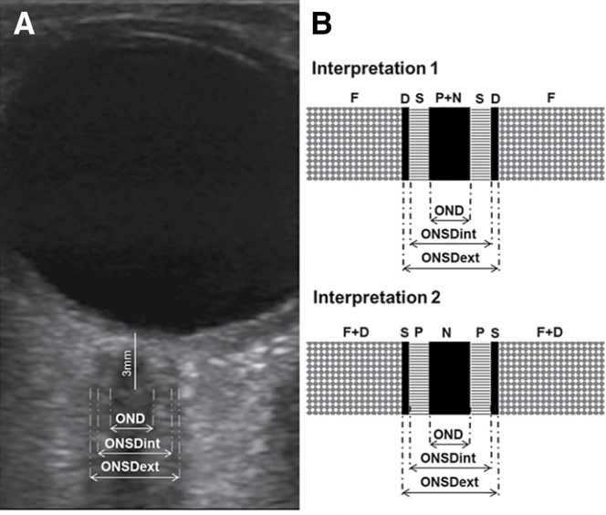 #HotoffthePress

Hirzallah et al: #ONSD  #POCUS Quality Criteria Checklist: An International Consensus Statement on #ONSD Imaging &amp; Measurement
📑23 quality criteria
👨‍🏫 50 experts

Link: ow.ly/YRKA50SflKu

#CritCareMed  #ultrasound <a href="/SCCM/">SCCM</a> 

Fig: ONSD  int &amp; ext measurements