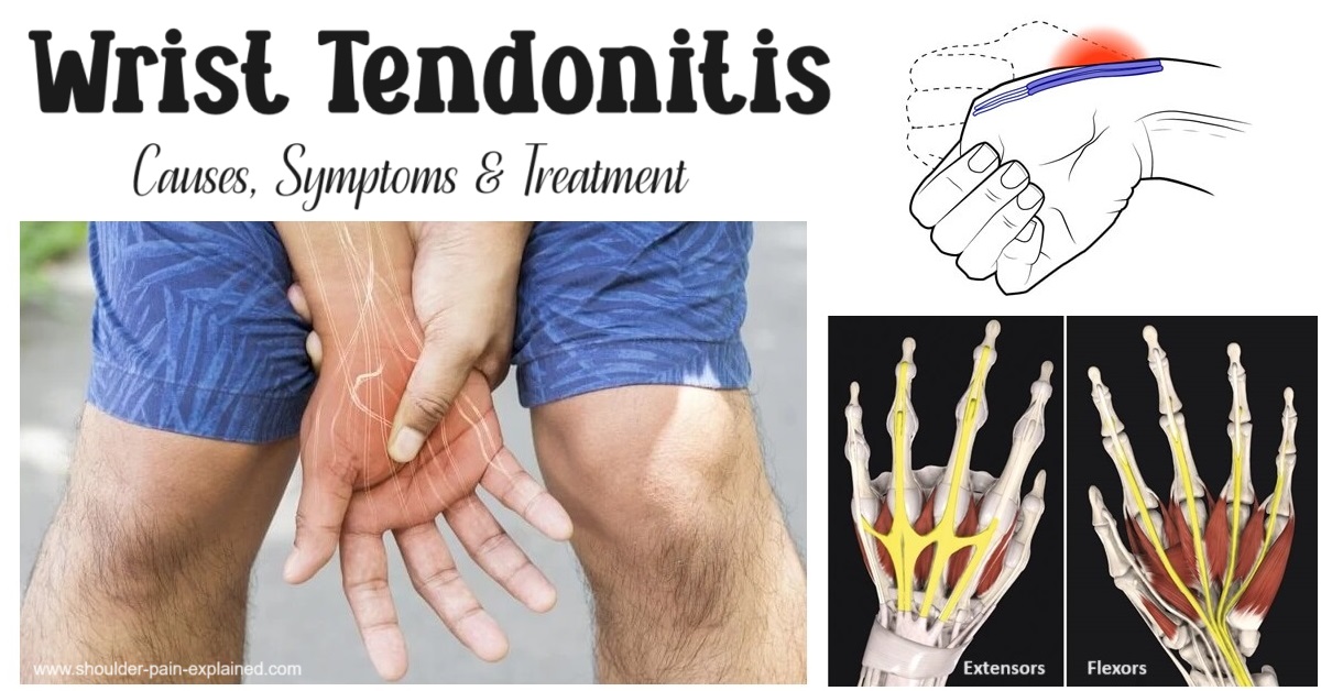 ShoulderPainExp's tweet photo. Wrist Tendonitis is a common problem causing wrist and hand pain when gripping, pulling and twisting. Find out about the causes, symptoms and treatment options for tendonitis of the wrist https://t.co/64bGg5qjkt https://t.co/6MiorYTG8F