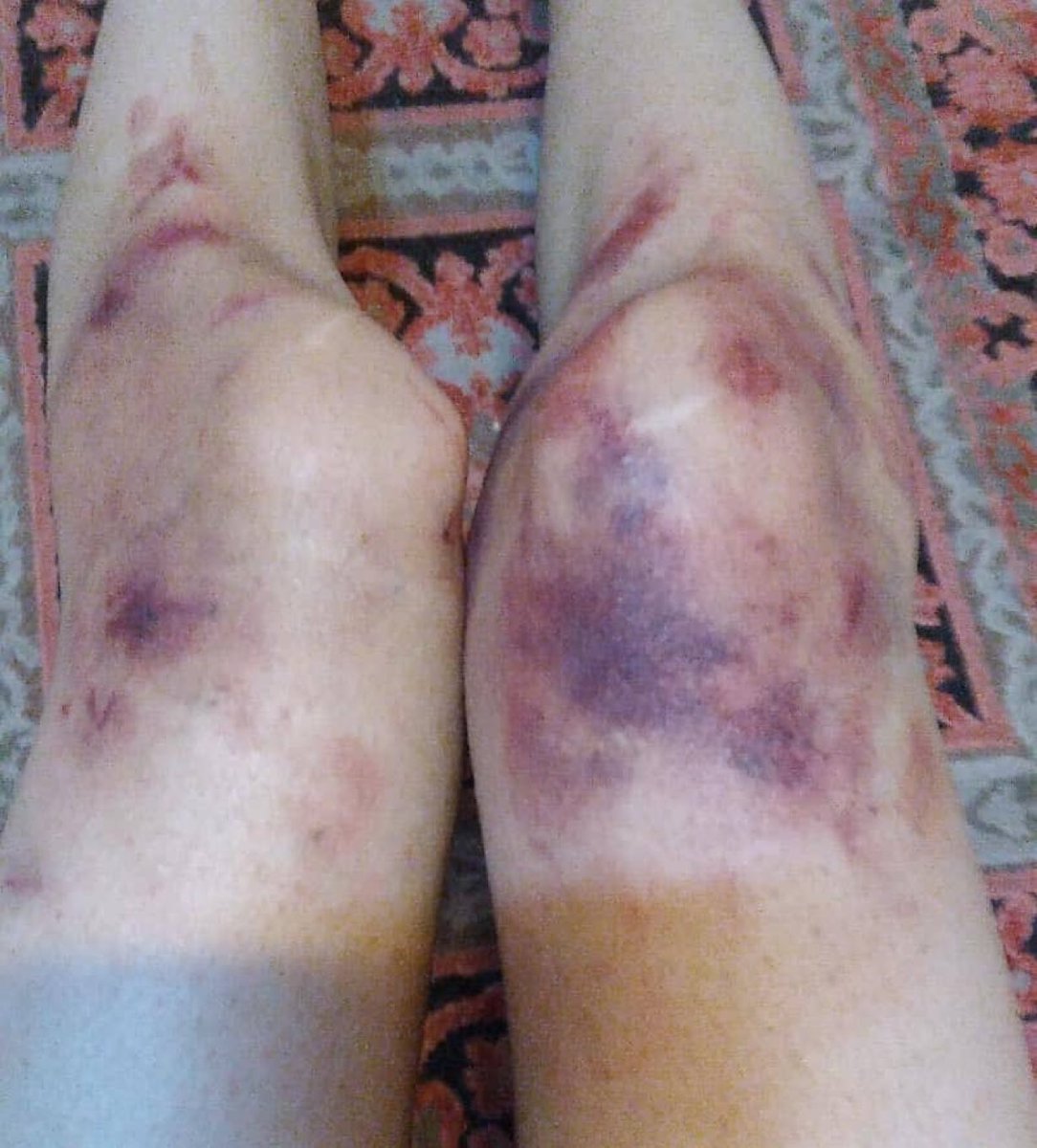 AzatAlsalim's tweet photo. This image shows the bruised legs of a woman who resisted being forced into a van by lsIamic regime thugs in Iran for not covering her hair. 

The photo was shared by Iranian on social media as reminder of Iranian people struggles for freedom. https://t.co/YhtYmDtTb3