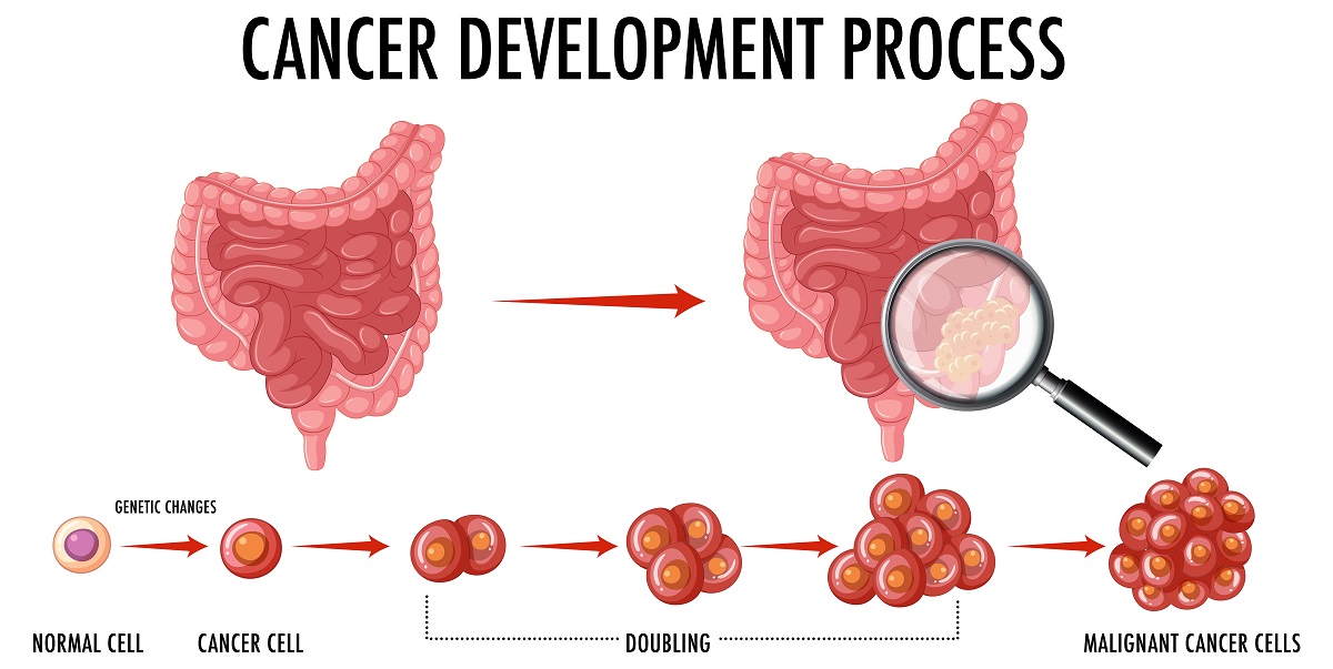 La Noticia del Día de <a href="/gTtVIH/">gTt-VIH</a>: La autoexploración puede facilitar la detección del cáncer anal en una fase temprana gtt-vih.org/publicaciones-…