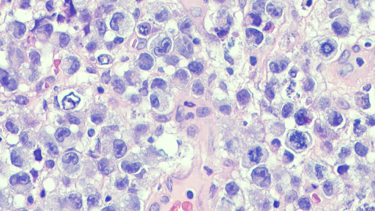 javidiparsijani's tweet photo. A great case of #ALK positive #ALCL (#Anaplastic large cell #lymphoma) involving the #bladder. #Hallmark cells (large horseshoe-shaped nuclei) are well demonstrated. Stains are CD30 and ALK-1.
#Tcell #lymphoma
#GUlymphoma https://t.co/3qCRweGaem
