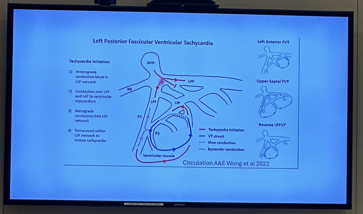 EugenioCingolan's tweet photo. Such a pleassure having Dr. Melvin Scheinman from @UCSFHospitals visiting #EP @SmidtHeart @CedarsSinaiMed ➡️ Discussing #EP cases with #EPfellows and #EPFaculty #EGM #ConductionSystem @CedarsSinai https://t.co/4iSucroWm6