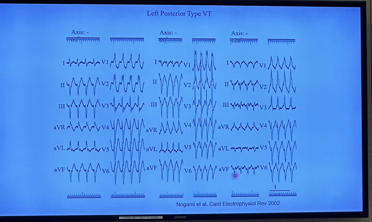 EugenioCingolan's tweet photo. Such a pleassure having Dr. Melvin Scheinman from @UCSFHospitals visiting #EP @SmidtHeart @CedarsSinaiMed ➡️ Discussing #EP cases with #EPfellows and #EPFaculty #EGM #ConductionSystem @CedarsSinai https://t.co/4iSucroWm6