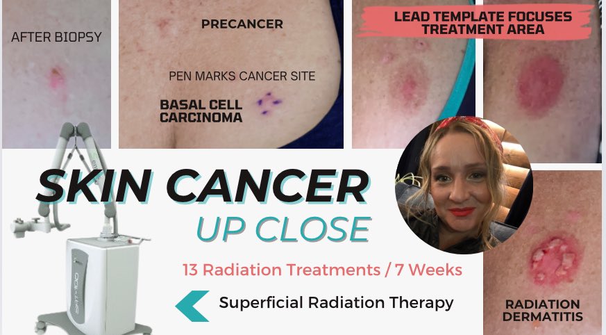 AZclinicalRN's tweet photo. With 1 more treatment to go, here’s a summary of my Basal Cell Carcinoma treatment

Thankful for technology like @SensusHealth which my physician used for treatments.

*not a paid testimonial https://t.co/FFbQwZufG4