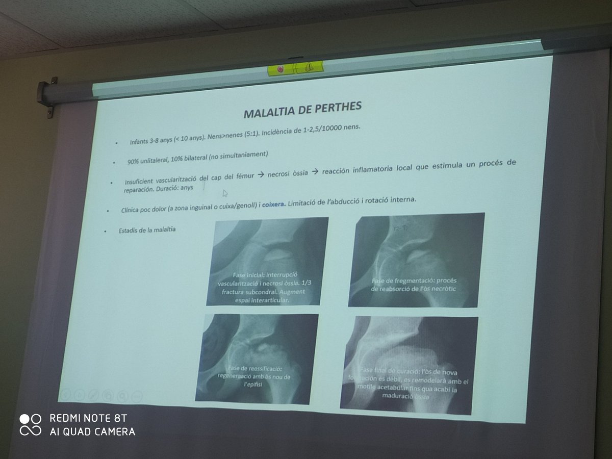Lluís Arcalà (@lluis1966) on Twitter photo Sessió de #pediatria avui a <a href="/eapeugeniaberga/">EAP Santa Eugènia</a> repassant les lesions traumàtiques sub-agudes a càrrec de la pediatra Anna Ricart 🔝
Gonàlgies mecàniques, contusions esportives i fractures per estrés en infants i adolescents <a href="/pediatresap/">SCPediatria_AP</a> <a href="/ResidentsCHV/">Residents.Vic</a> <a href="/u_medicina/">Facultat de Medicina UVic-UCC</a> <a href="/icscatcentral/">ICS Catalunya Central</a> Sessió de #pediatria avui a <a href="/eapeugeniaberga/">EAP Santa Eugènia</a> repassant les lesions traumàtiques sub-agudes a càrrec de la pediatra Anna Ricart 🔝
Gonàlgies mecàniques, contusions esportives i fractures per estrés en infants i adolescents <a href="/pediatresap/">SCPediatria_AP</a> <a href="/ResidentsCHV/">Residents.Vic</a> <a href="/u_medicina/">Facultat de Medicina UVic-UCC</a> <a href="/icscatcentral/">ICS Catalunya Central</a>