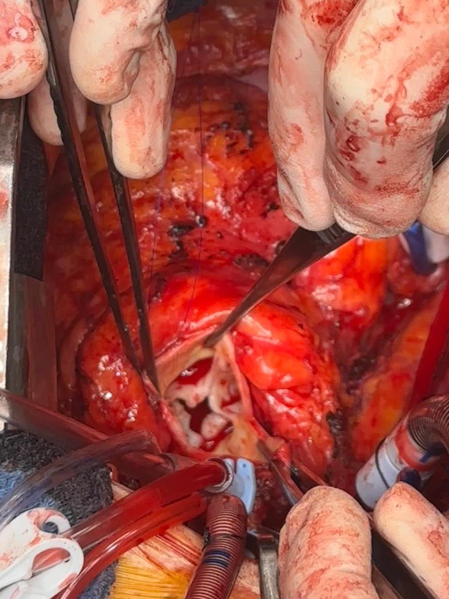 drEdgarFuentes's tweet image. 🚩 An unusual finding: a 4️⃣quadricuspid aortic valve 🍀.

Thank’s to Dra. Irene Bolaños for 🔪 and 📸.

@ASE360 @Sochicaroficial @SONECOM_AC @SISIACOficial @echo_stepbystep @MigueldeBoedo @mariovar55 @robertomlang @VazyurVasquez @vazzny74 @fiore_corrado @MAecocardio
