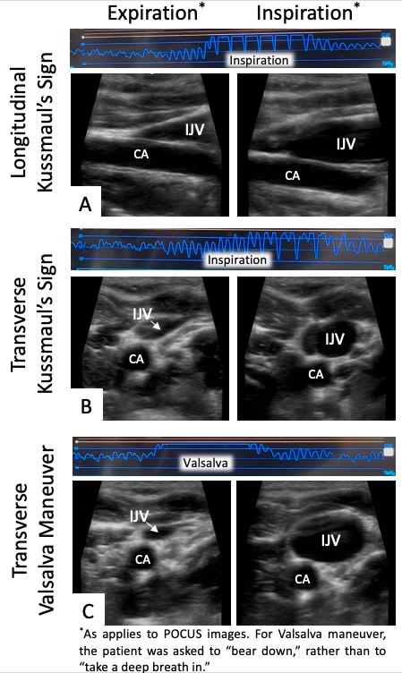 Circ: Heart Failure (@circhf) on Twitter photo We present the initial report (to our knowledge) of Kussmaul's sign assessed by point-of-care ultrasound (uKussmaul) <a href="/AngelaDuvalyan/">Angela Duvalyan</a> <a href="/MarkDrazner/">Mark Drazner</a> @UTSWheart <a href="/UTSWIMchief/">UTSW Internal Medicine Chiefs</a> <a href="/JTThibs/">Jenny Thibodeau, MD, MSCS</a> #AHAJournals ahajrnls.org/4ekn5rs We present the initial report (to our knowledge) of Kussmaul's sign assessed by point-of-care ultrasound (uKussmaul) <a href="/AngelaDuvalyan/">Angela Duvalyan</a> <a href="/MarkDrazner/">Mark Drazner</a> @UTSWheart <a href="/UTSWIMchief/">UTSW Internal Medicine Chiefs</a> <a href="/JTThibs/">Jenny Thibodeau, MD, MSCS</a> #AHAJournals ahajrnls.org/4ekn5rs